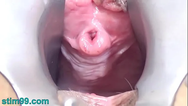 Mature Woman Peehole Endoscope Camera in Bladder with Balls
